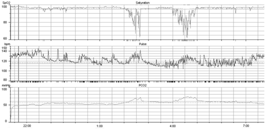 夜間の呼吸モニタリング